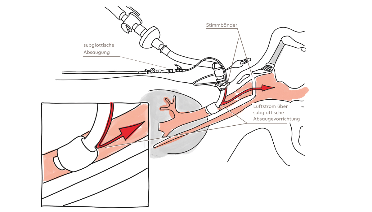 Above Cuff Vocalisation Schematische Darstellung