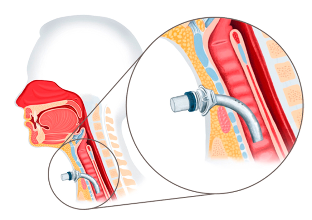 Anatomische Illustration eines Menschen mit Tracheotomie