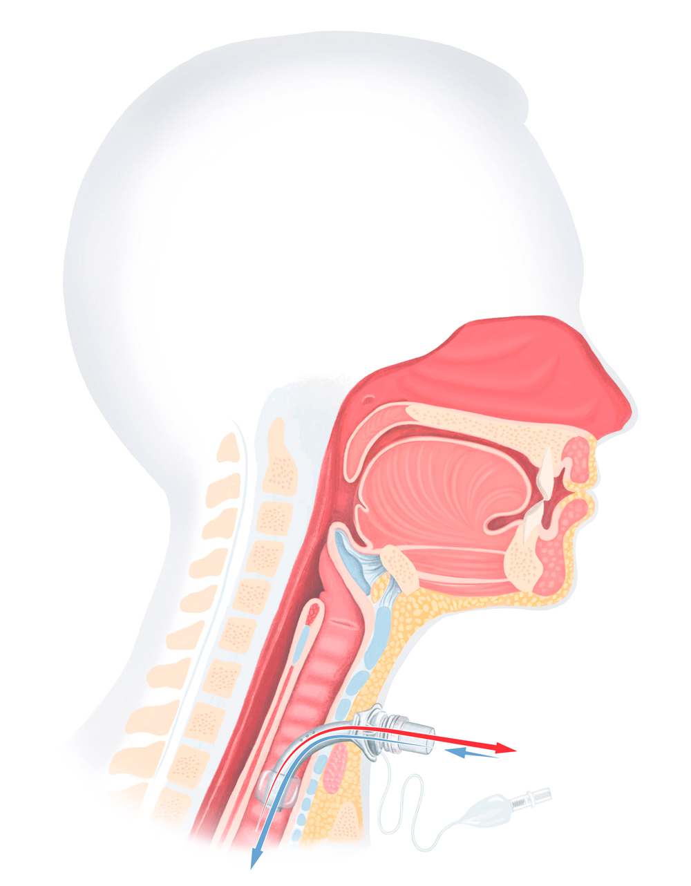 Anatomische Illustration eines Menschen mit Luftzirkulation nach der Tracheotomie. Geblockter Cuff