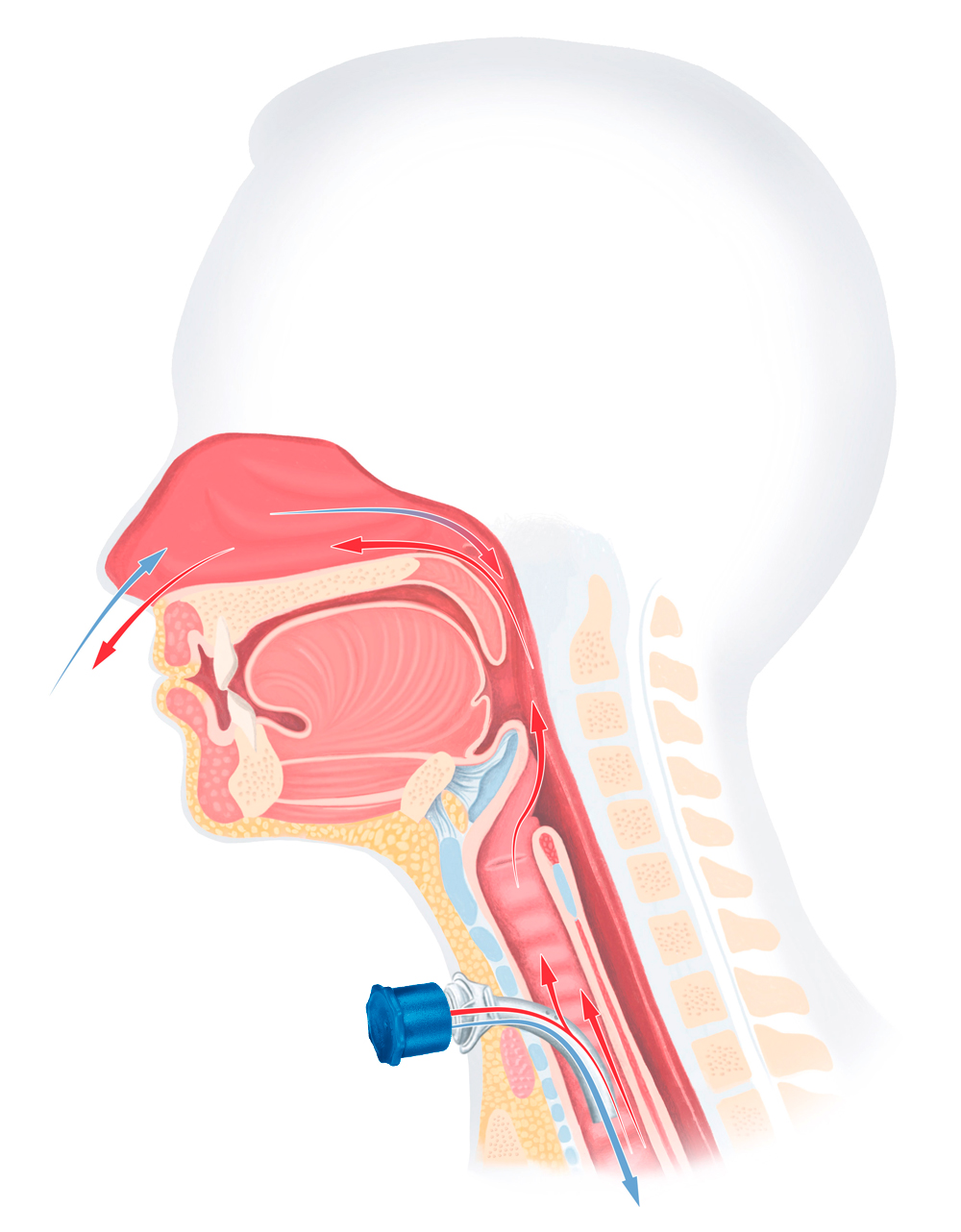 Anatomische Illustration eines Menschen mit Luftzirkulation nach der Tracheotomie. Mit Tracoe Verschlusskappe.